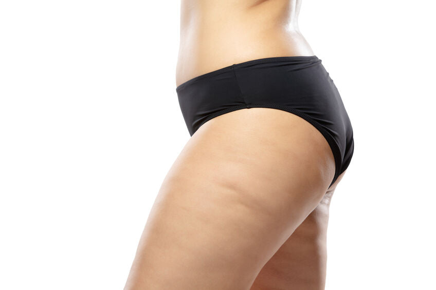 Why Cellulite Is More Common in Women than Men